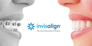 Invisalign Blockhouse Bay